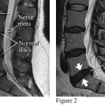 I'll spare you the picture of the knife injury, but I thought this was interesting. The MRI revealed two herniated discs that were the source of my back pain.